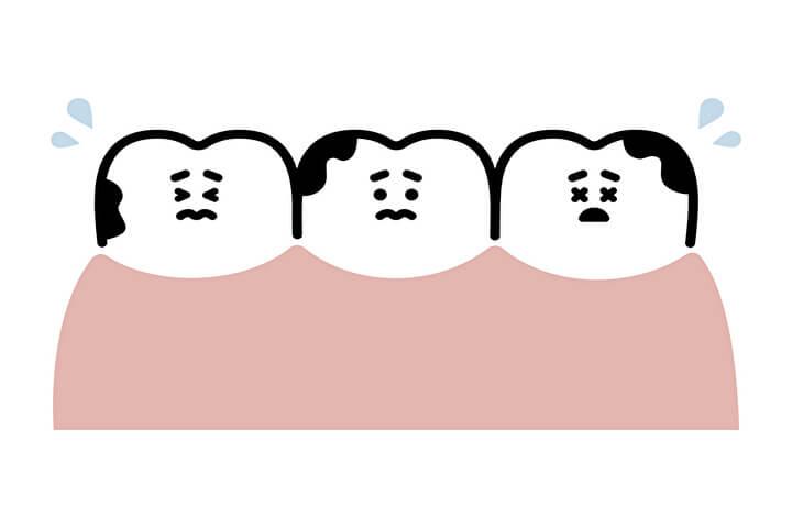 虫歯とはどのような状態？原因や放置する危険性を解説