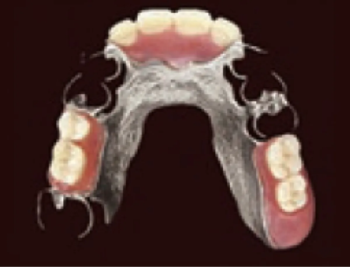 コバルトクロム床義歯